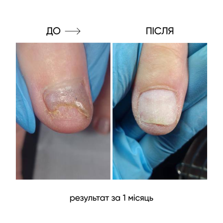 NAILSOFTHEDAY ONISTOP – регенеруюча олія проти оніхолізису, 8 мл