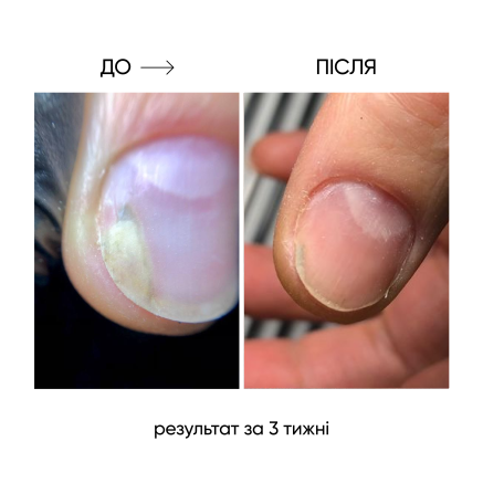 NAILSOFTHEDAY ONISTOP – регенеруюча олія проти оніхолізису, 8 мл