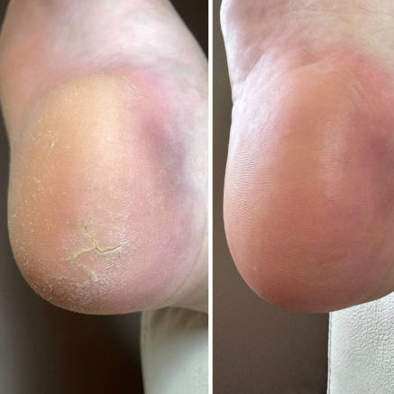 Nailsoftheday Podology+ КРЕМ від тріщин на шкірі рук та стоп, urea 12%, 30 мл
