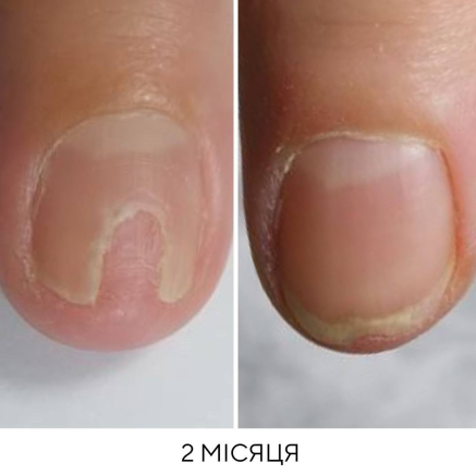 NAILSOFTHEDAY ONISTOP – регенеруюча олія проти оніхолізису, 15 мл