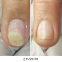 NAILSOFTHEDAY ONISTOP – регенеруюча олія проти оніхолізису, 8 мл