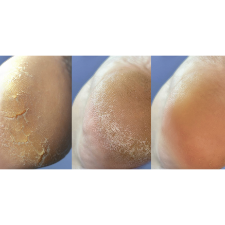 Nailsoftheday Podology+ КРЕМ від тріщин на шкірі рук та стоп, urea 12%, 30 мл