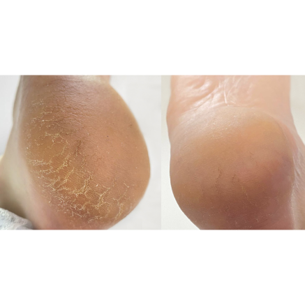 Nailsoftheday Podology+ КРЕМ від тріщин на шкірі рук та стоп, urea 12%, 30 мл